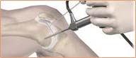 ARTHROSCOPIC SURGERY