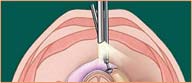 ENDOSCOPIC SURGERY